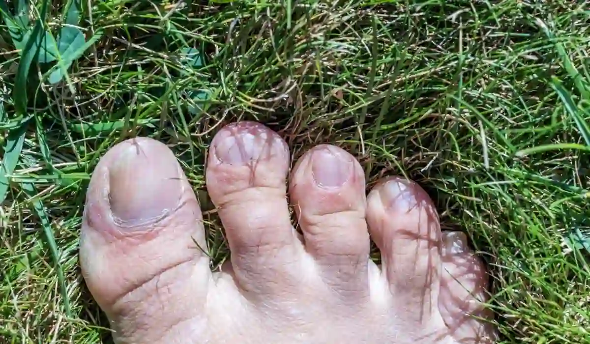 Toenail Fungal Home Remedies- How To Use And Causes