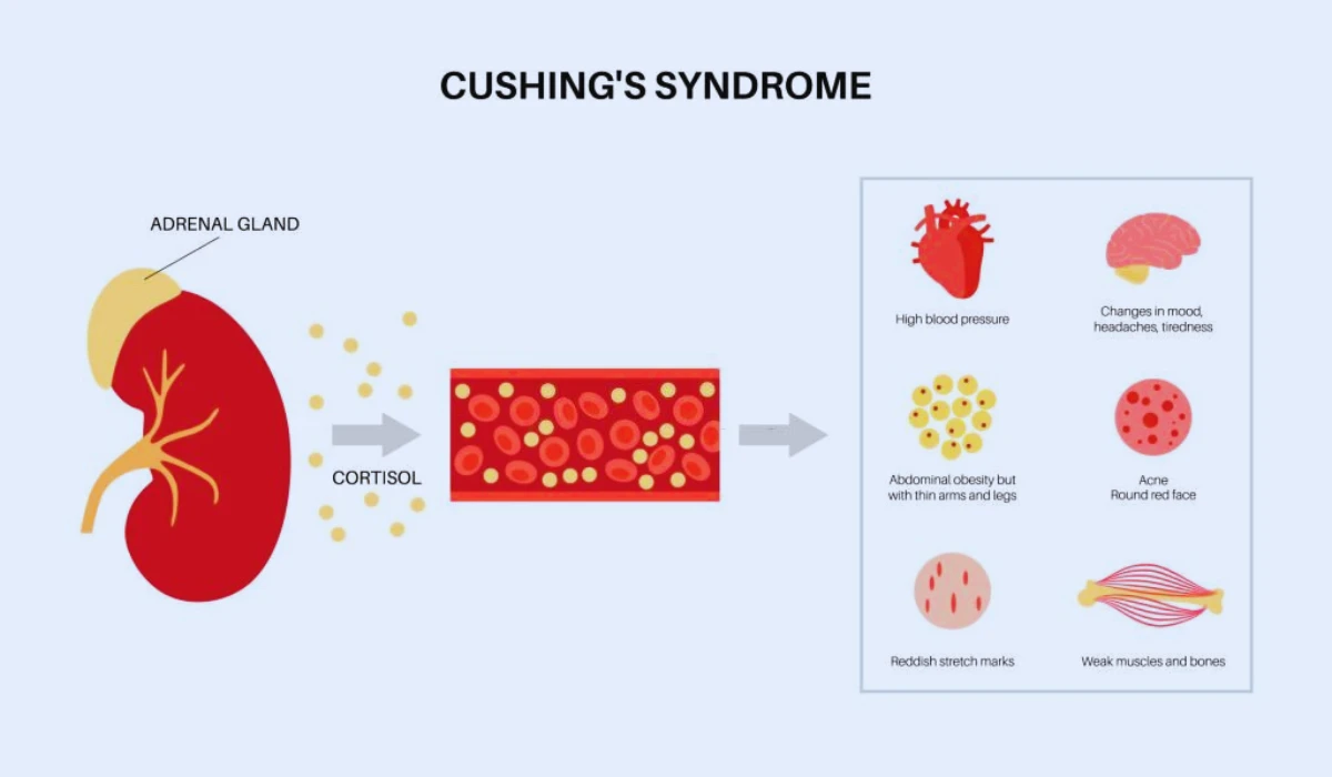 Causes Of Cushing Syndrome