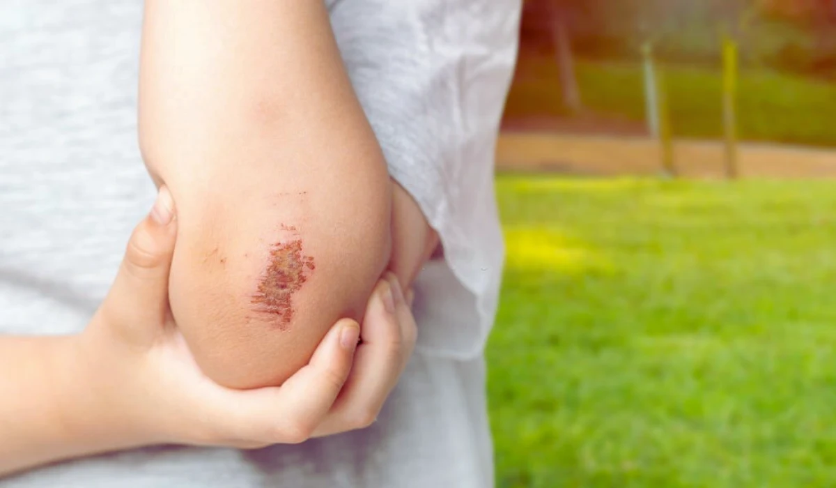 How to heal scraped skin