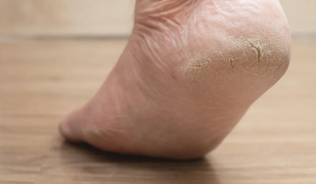Understanding and Treating Fissures on Feet